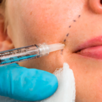 first-time patients know before getting facial fillers