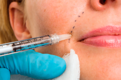 first-time patients know before getting facial fillers