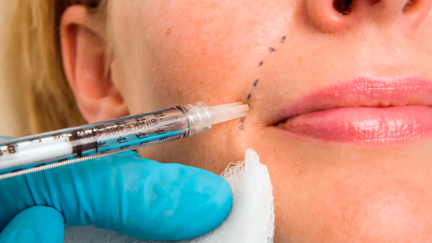 first-time patients know before getting facial fillers