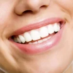 Teeth Whitening