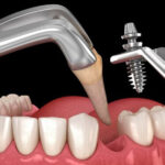 Immediate or Delayed? Making the Right Call on Dental Implants After a Tooth Extraction in Franklin