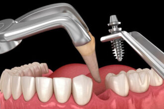 Immediate or Delayed? Making the Right Call on Dental Implants After a Tooth Extraction in Franklin