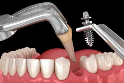 Immediate or Delayed? Making the Right Call on Dental Implants After a Tooth Extraction in Franklin
