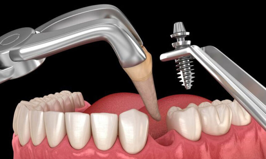 Immediate or Delayed? Making the Right Call on Dental Implants After a Tooth Extraction in Franklin