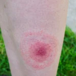 6 Best Lyme Disease Care Options in Connecticut for Persistent Symptoms